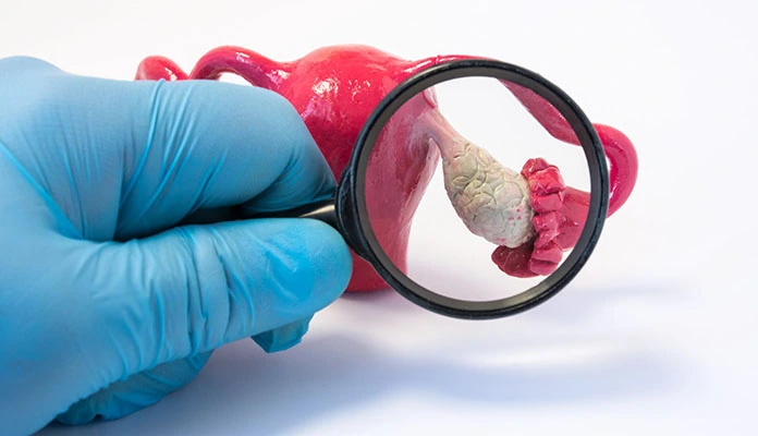 Polikistik Over Sendromu