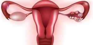 Endometriozis Çikolata Kisti Kimlerde Görülür, Nasıl Tedavi Edilir?