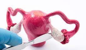 Polikistik over sendromu hakkında doğru bilinen yanlışlar