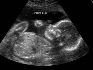 Ultrasonda Bebek Gelişiminin İzlenmesi