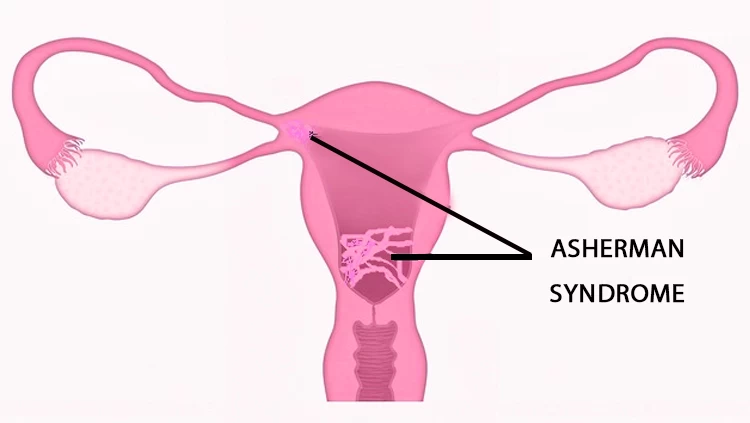 What Is Asherman Syndrome?