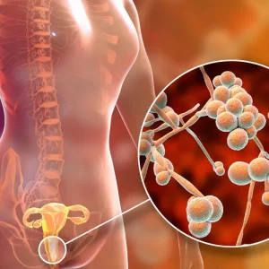 What Is a Vaginal Yeast Infection?