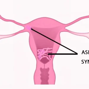 What Is Asherman Syndrome?