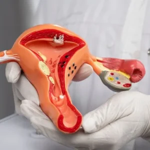 Dermoid Kist Nedir?