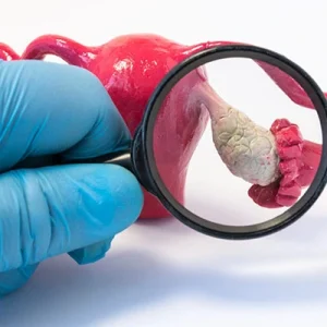 Polikistik Over Sendromu